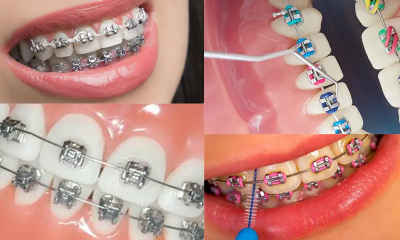 Diş Teli Kullanımı: Sağlıklı Dişler İçin Önemli Bir Adım